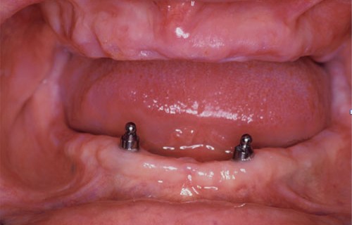 Jaw 
      Registration For Complete Dentures Medora IL 62063